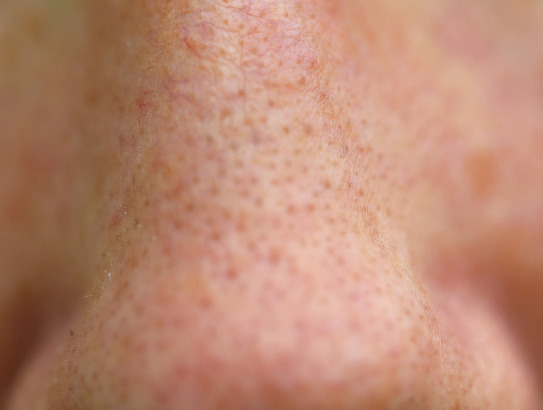 How to Get Rid of Clogged Pores?